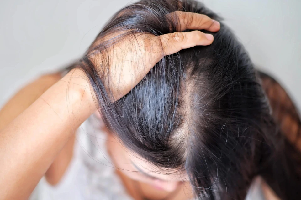 5.Is it usual for women to lose hair?